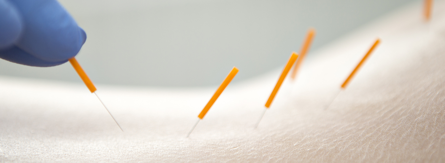 Silderbild: Akupunktur